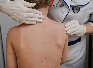São Paulo, São Bernardo do Campo e Guarulhos confirmam casos de sarampo
