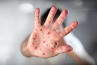 Vacinas contra o sarampo salvam cinco vidas por segundo